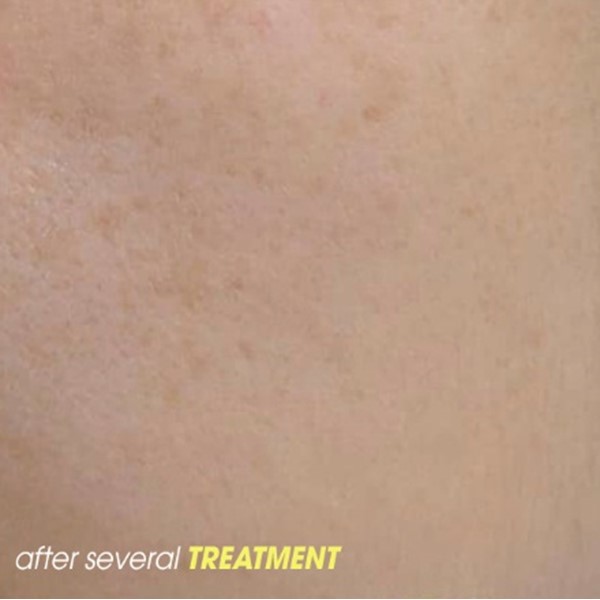 Ultherapy